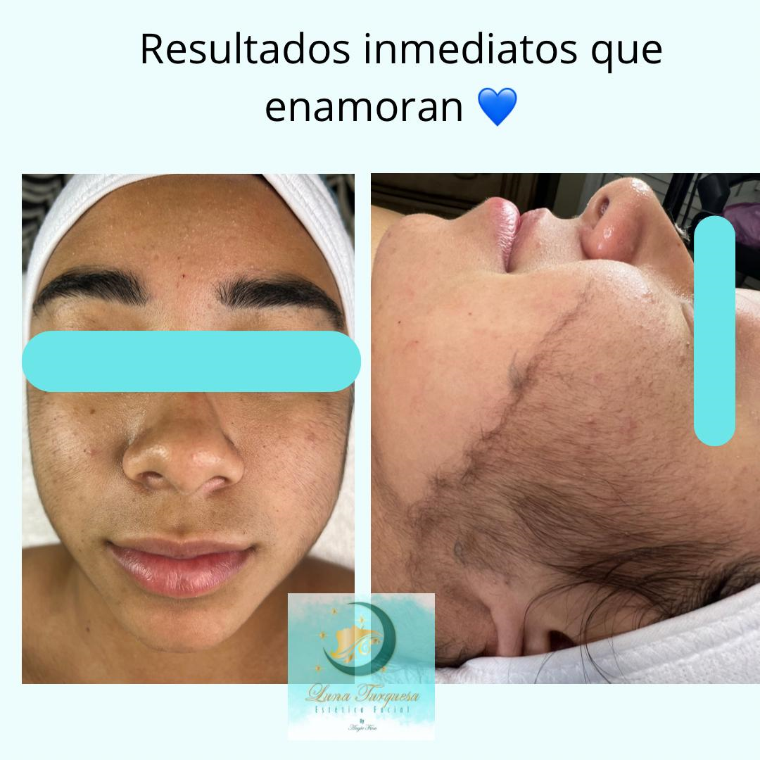 Dermaplaning