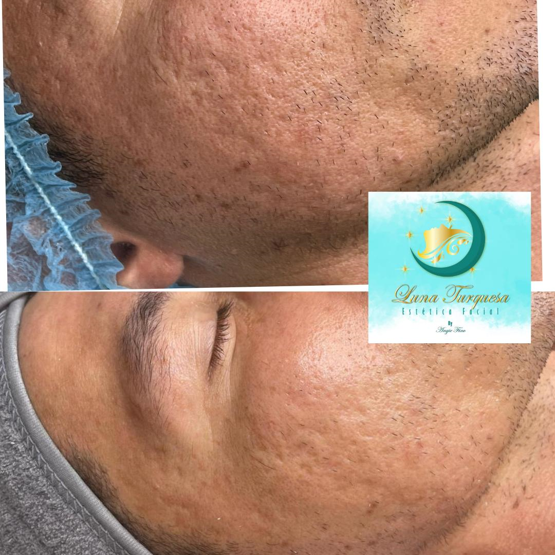 Limpieza facial básica