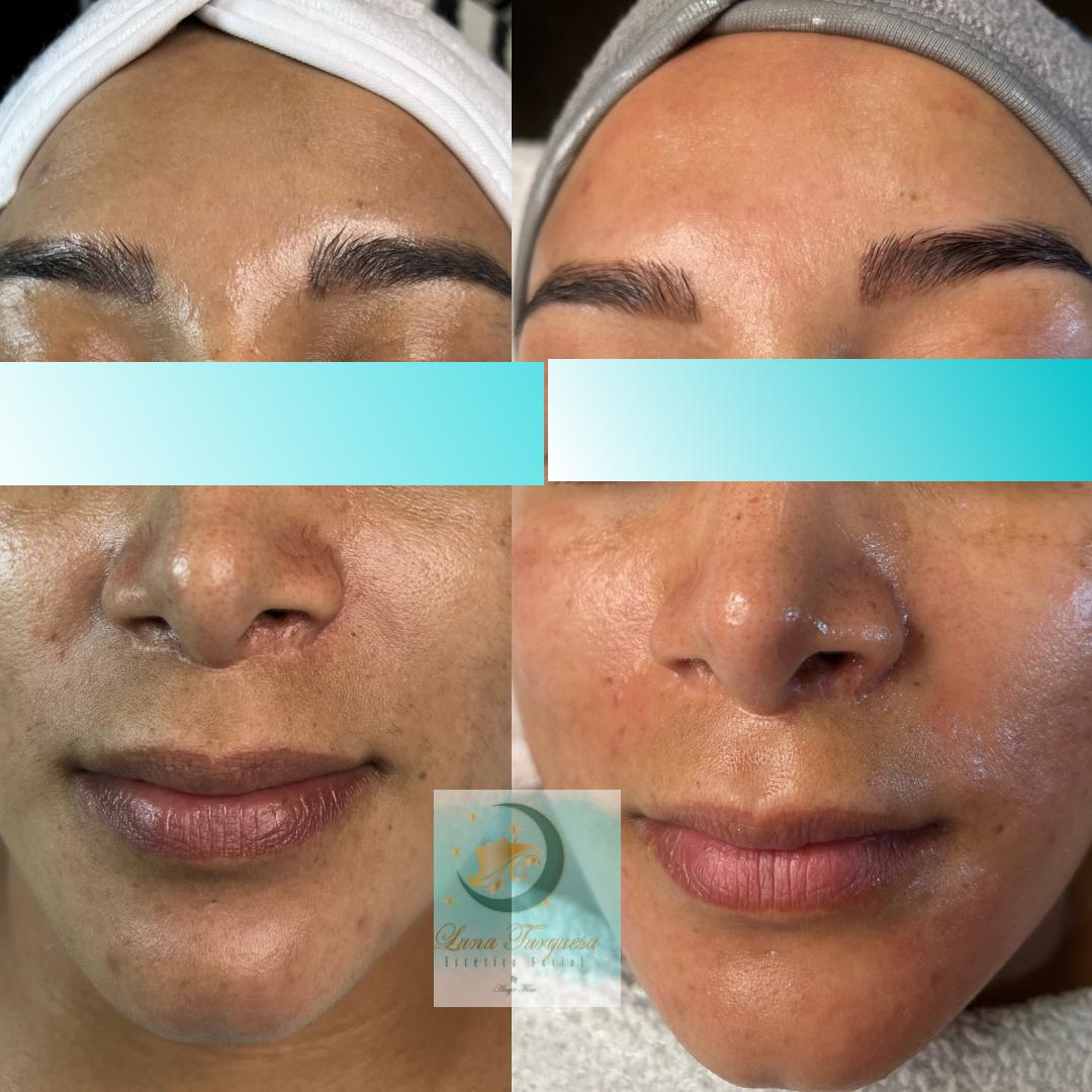 Limpieza facial profunda
